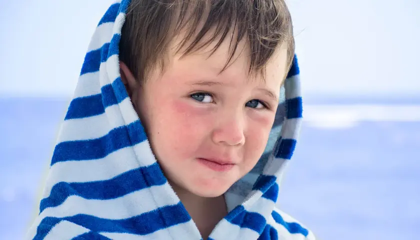 Bambino con guance arrossate, forse per la dermatite da sabbia, avvolto in un accappatoio a righe blu e bianche.