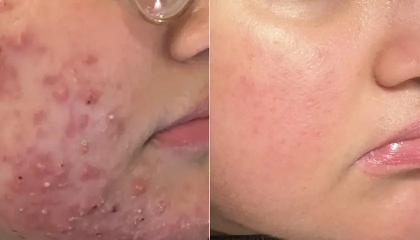 Före- och efterbilder visar hud med akne som blivit slät. En fin, rak mustasch kan nu framhävas.