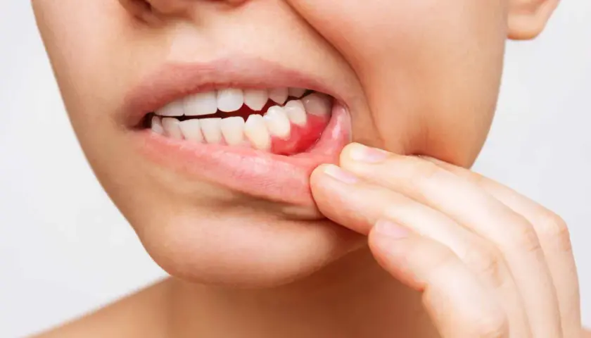 Encía inflamada y enrojecida, señal de qué es la periodontitis.