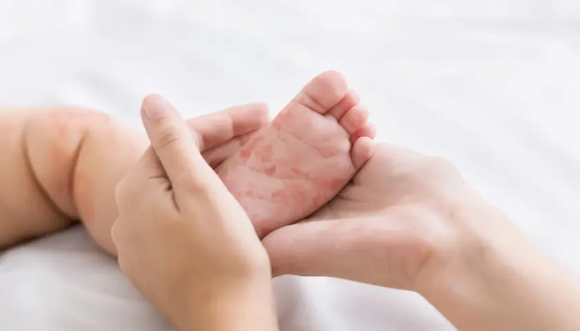 Pieds et mains rouges d'un bébé, possiblement liés au traitement du pied-main-bouche.