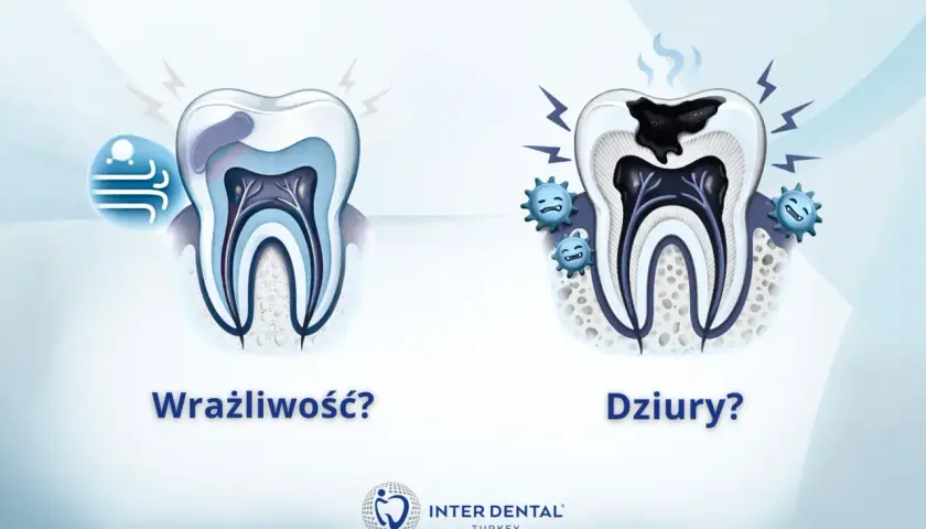 Porównanie zdrowego zęba z zębem z próchnicą. Objawy nadwrażliwości zębów i próchnicy.