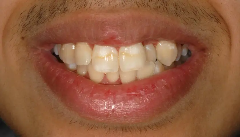 Denti con macchie bianche, possibili segni di carie iniziale.