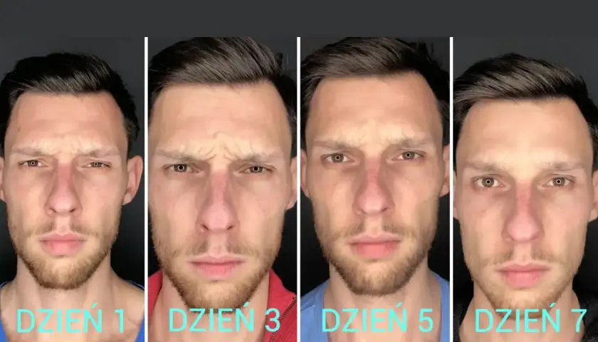 Postęp zabiegu botox dzień po dniu. Mężczyzna na zdjęciach pokazuje zmiany na swojej twarzy po zabiegu.