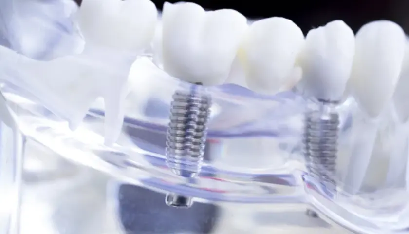 Model szczęki z implantami zębowymi. Sprawdź, czy przysługuje Ci dofinansowanie do implantów zębowych.