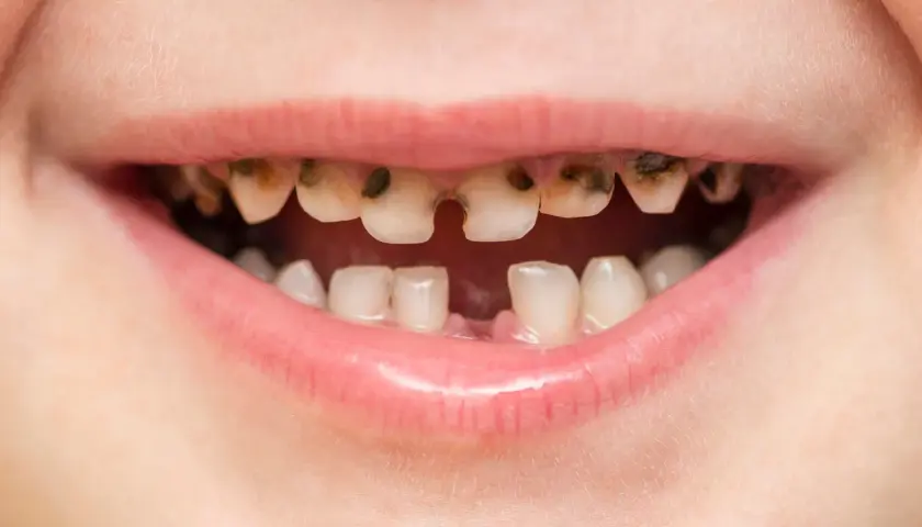 Boca de niño con dientes muy dañados por caries, algunos rotos y oscuros. Es importante recordar que las caries se contagian.