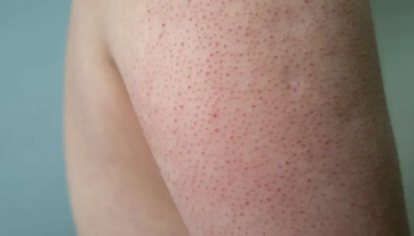 Närbild på knottriga ben med små röda prickar. Huden ser lite irriterad ut.