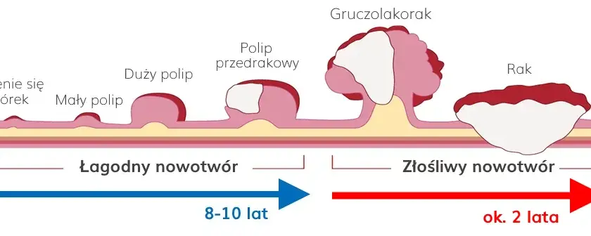 Stolec przy raku jelita grubego: kluczowe zmiany i objawy