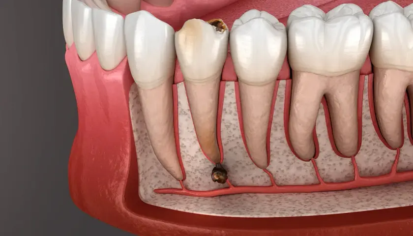 Corte transversal de una muela con caries avanzada y absceso. La infección se extiende a la raíz, mostrando las posibles consecuencias de no extraer una muela con infección.