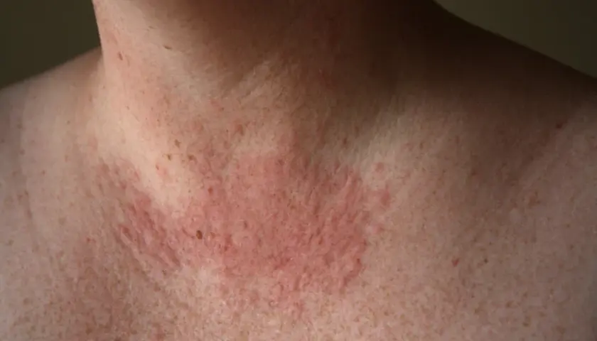 Piel enrojecida y con erupciones en el cuello y pecho, indicativo de una posible alergia al sol.