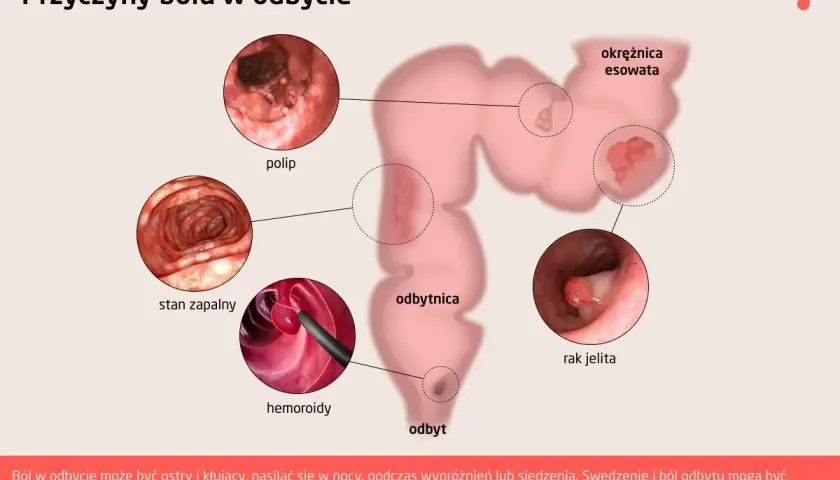 Ilustracja przedstawia schemat jelita grubego z zaznaczonymi zmianami: polip, stan zapalny, hemoroidy, rak jelita.