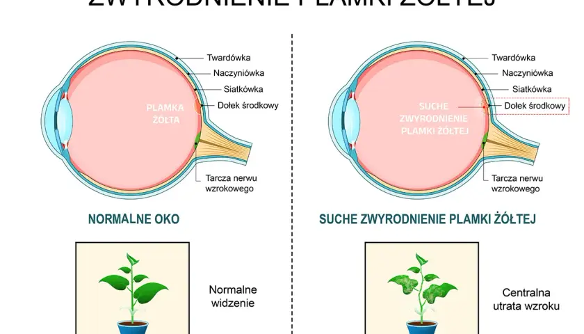 Porównanie zdrowego oka z suchym zwyrodnieniem plamki żółtej, pokazujące utratę ostrości widzenia.
