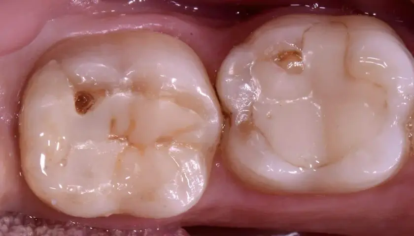 Due denti con un piccolo buco nel dente senza carie, forse un segno di usura o un'antica otturazione.