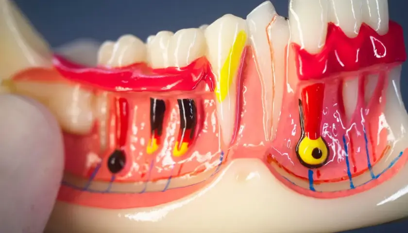 Modello anatomico di denti e gengive, con evidenziati nervi e vasi sanguigni. Si nota il colletto dentale e la struttura ossea.