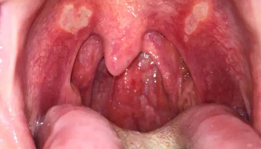 Gola arrossata con afte sul palato e sulle tonsille. Si notano lesioni biancastre e infiammazione.