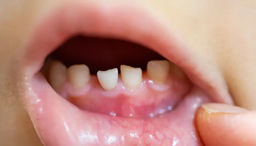 Bocca di bambino con denti da latte spuntati, gengive arrossate. Potrebbe essere la **febbre da dentizione**.