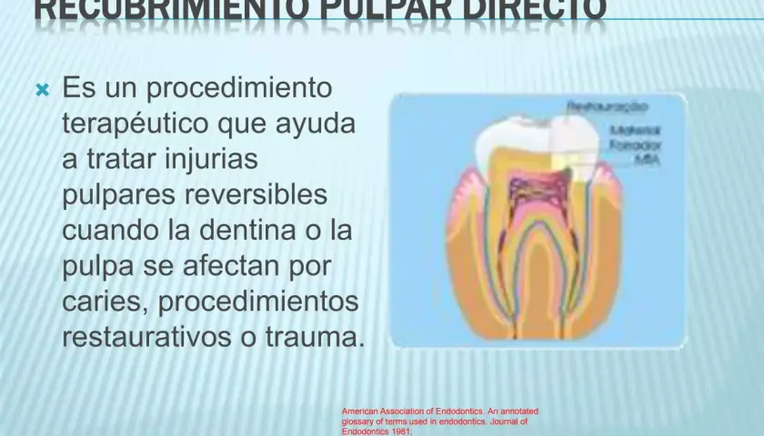 Diagrama de un diente mostrando el recubrimiento pulpar directo, un procedimiento para tratar injurias reversibles en la pulpa dental.