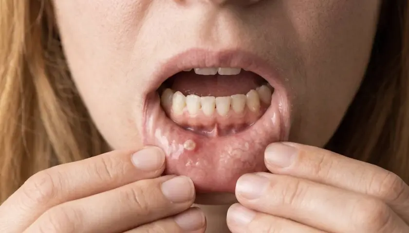 Otwarta jama ustna z widoczną raną na dolnej wardze, która może być objawem raka płaskonabłonkowego.