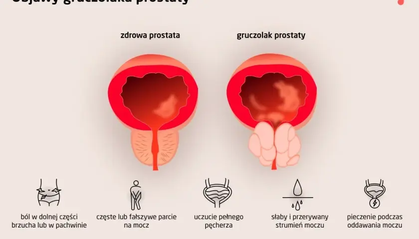Porównanie zdrowej prostaty i gruczolaka prostaty. Obrazek ilustruje objawy przerostu prostaty, takie jak ból, częste parcie na mocz i słaby strumień.