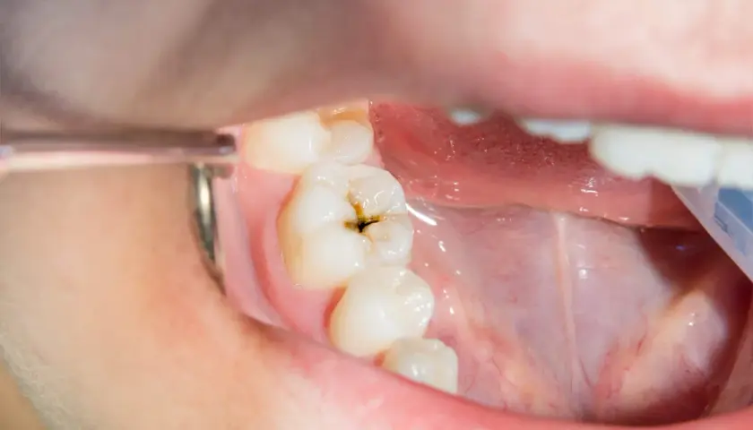 Diente con una cavidad oscura, mostrando por qué salen caries.