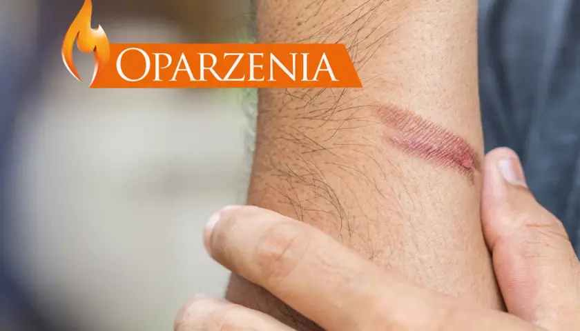 Oparzenia na skórze. Dowiedz się, jak udzielić pierwszej pomocy przy oparzeniach, aby zminimalizować szkody.