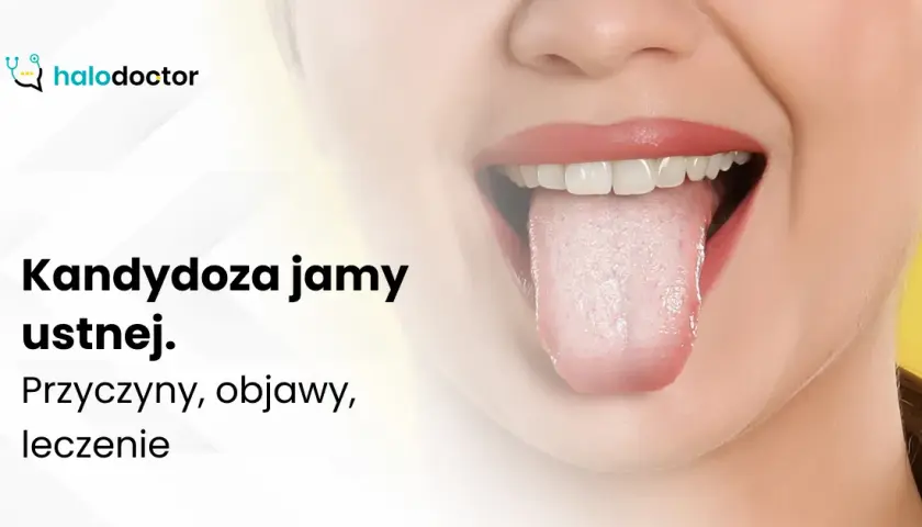 Kandydoza jamy ustnej: objawy, przyczyny i kiedy iść do lekarza