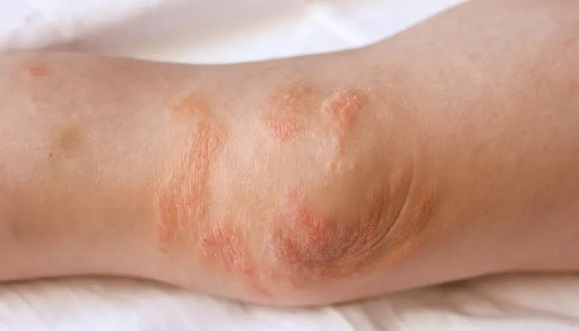 Codo con parches rojos y escamosos, indicativos de eczema. La piel está irritada y seca.