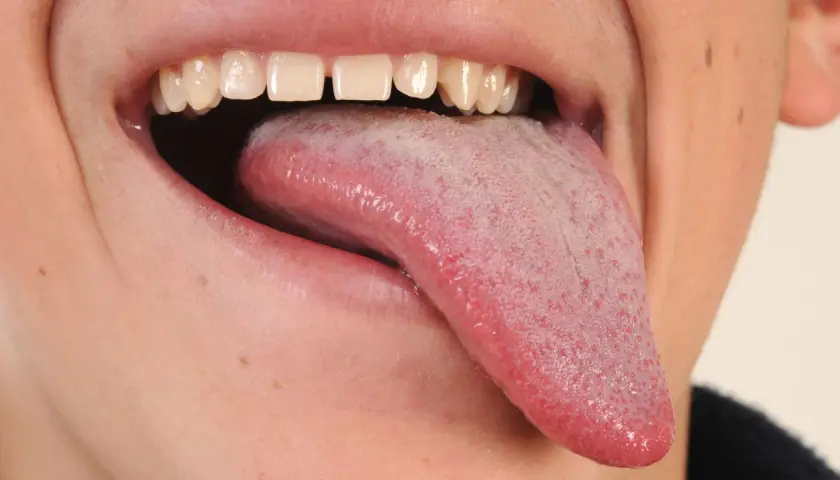 Boca abierta mostrando lengua rosada con pequeñas protuberancias rojas, quizás por eso salen granos en la lengua.