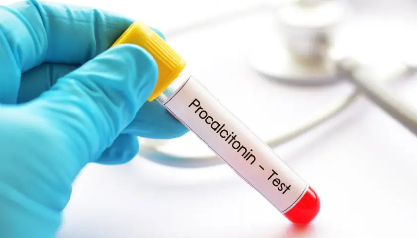 Ręka w niebieskiej rękawiczce trzyma probówkę z napisem "Procalcitonin - Test".