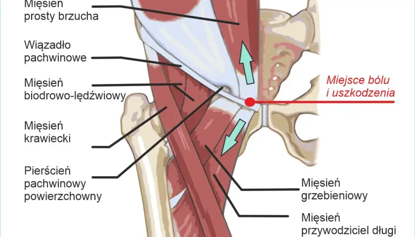 Anatomia pachwiny piłkarza: mięsień prosty brzucha, wiązadło pachwinowe, mięsień biodrowo-lędźwiowy, mięsień krawiecki, pierścień pachwinowy powierzchowny, mięsień grzebieniowy, mięsień przywodziciel długi. Miejsce bólu i uszkodzenia.