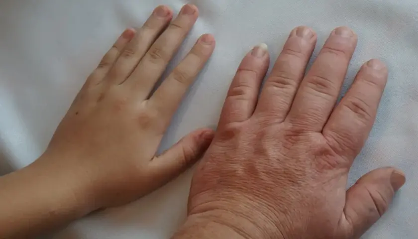 Dłoń dziecka obok dłoni dorosłego z widocznymi objawami akromegalii, wskazującymi na przerost kości i tkanek.