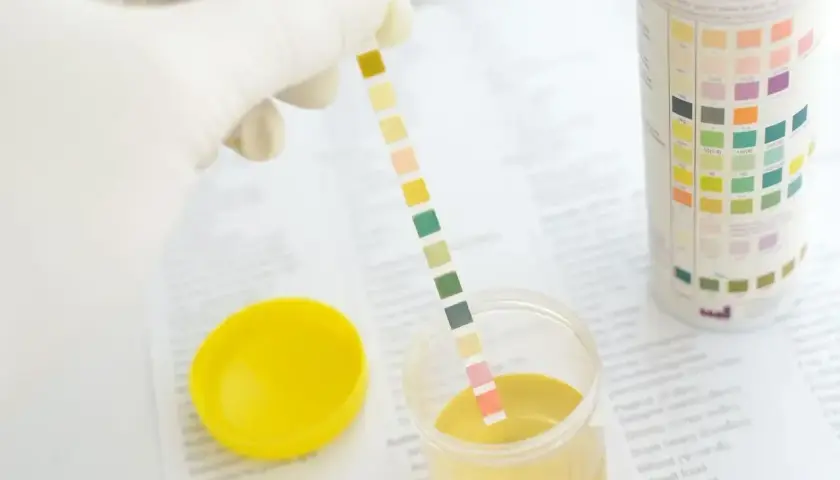 Rękawiczka trzyma pasek testowy do analizy moczu, który pokazuje obecność nabłonków płaskich. Obok pojemnik z żółtym płynem i żółta nakrętka.