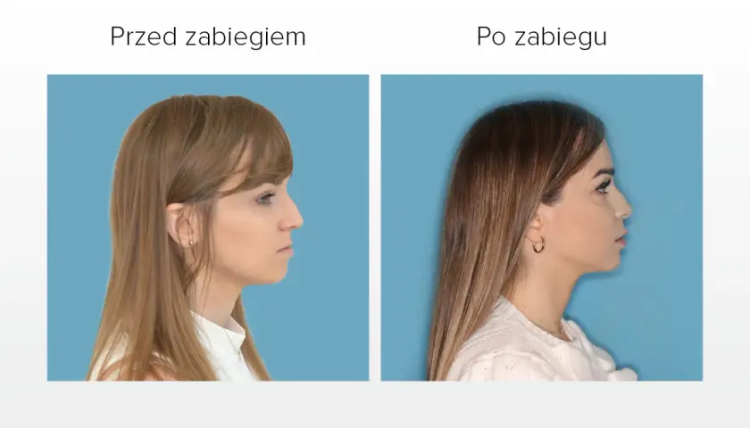Przed i po zabiegu korekty profilu. Widoczna poprawa linii żuchwy, która wcześniej była lekko krzywa.