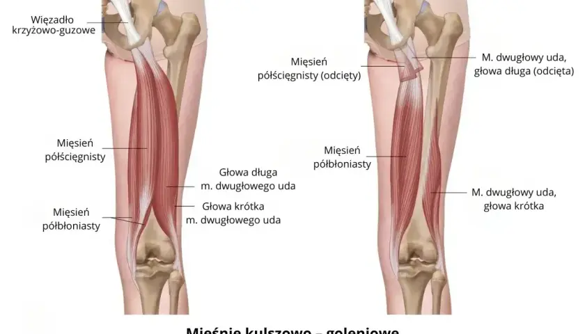 Anatomia mięśni kulszowo-goleniowych. Ilustracja pokazuje mięsień dwugłowy uda, który może powodować ból w podudziu.