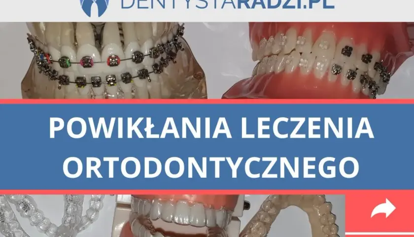 Modele szczęk z aparatami ortodontycznymi i nakładkami. Temat: powikłania leczenia ortodontycznego, w tym ból zębów po zdjęciu aparatu.
