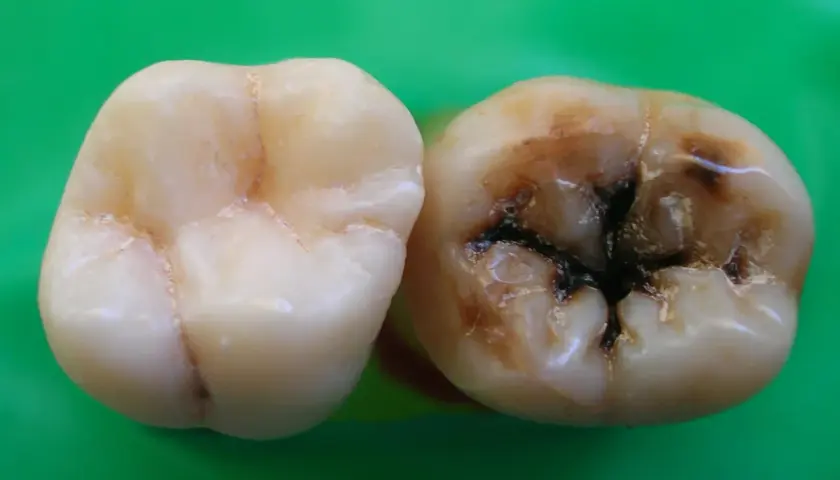Un diente sano junto a otro con caries avanzadas, oscuras y profundas. Las caries duelen y arruinan la sonrisa.