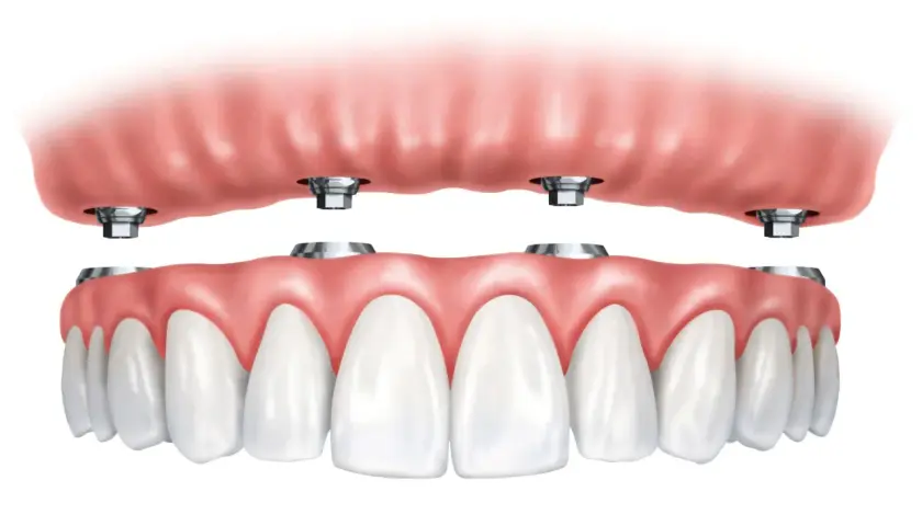 Arcata dentale superiore con impianti dentali. La protesi superiore si aggancia a quattro pilastri metallici.