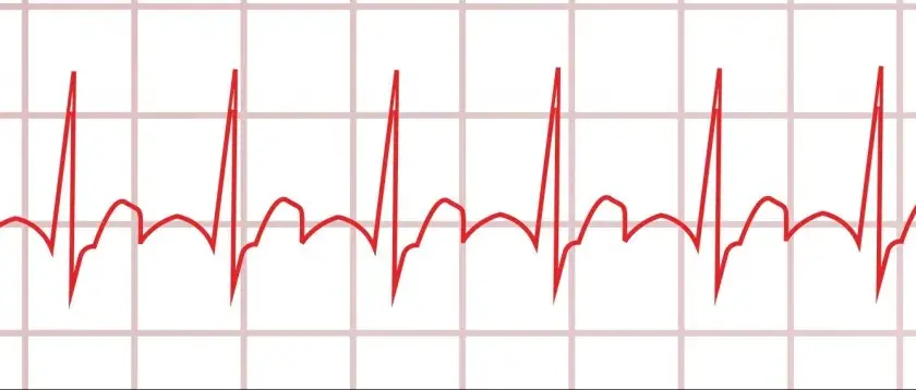 Myokarditis Diagnostik EKG: EKG-Befunde verstehen und richtig deuten