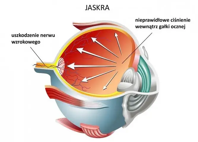 Czy jaskra jest wyleczalna? Odkryj prawdę o leczeniu tej choroby