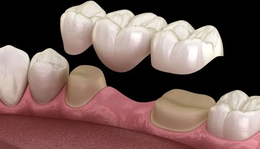 Un ponte dentale che sostituisce un dente mancante, ancorato a corone su denti adiacenti.