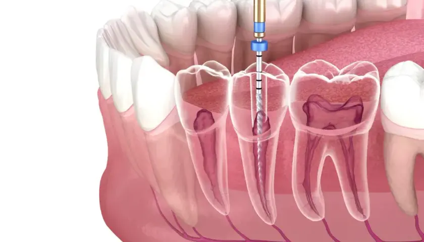 Jak bezpiecznie usunąć ząb? Kiedy dentysta, a kiedy domowe sposoby?