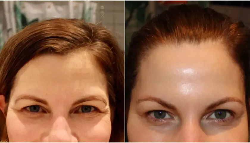 Före- och efterbilder visar hur man kan få bort bekymmersrynka utan botox. Pannan ser slätare ut på efterbilden.
