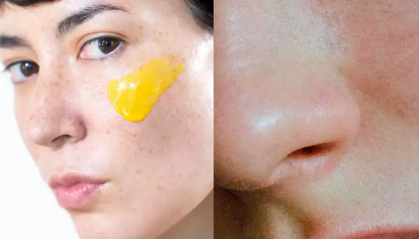 Nära bild på ansikte med gul kräm på kinden, möjligen för att behandla rosacea. Retinol kan vara en del av behandlingen.