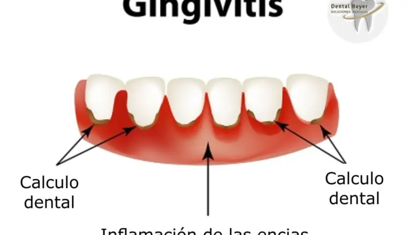 Encías inflamadas y con sarro, indicando gingivitis grave. Se observa cálculo dental y la inflamación de las encías.