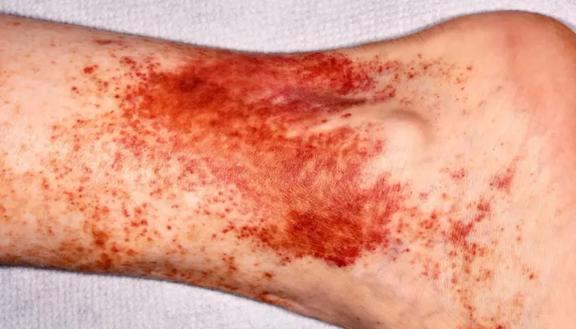 Piel con manchas oscuras y rojizas en la zona del tobillo y la parte baja de la pierna, indicando posibles hematomas o petequias.