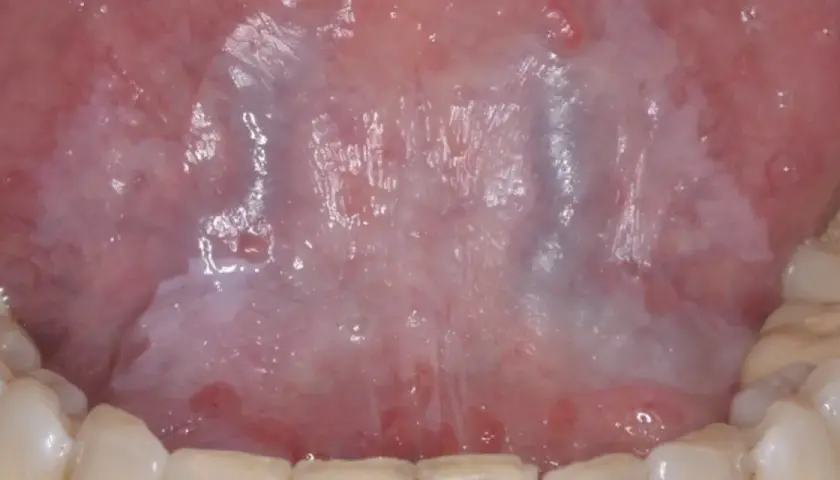 Vista detallada de la lengua mostrando áreas blanquecinas y rojizas, indicativas de leucoplasia en la lengua.