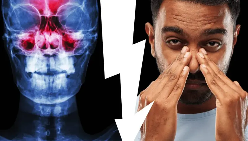 Radiografia del cranio che mostra l'anatomia del seno mascellare infiammato, accanto a un uomo che si tocca il naso per il dolore.