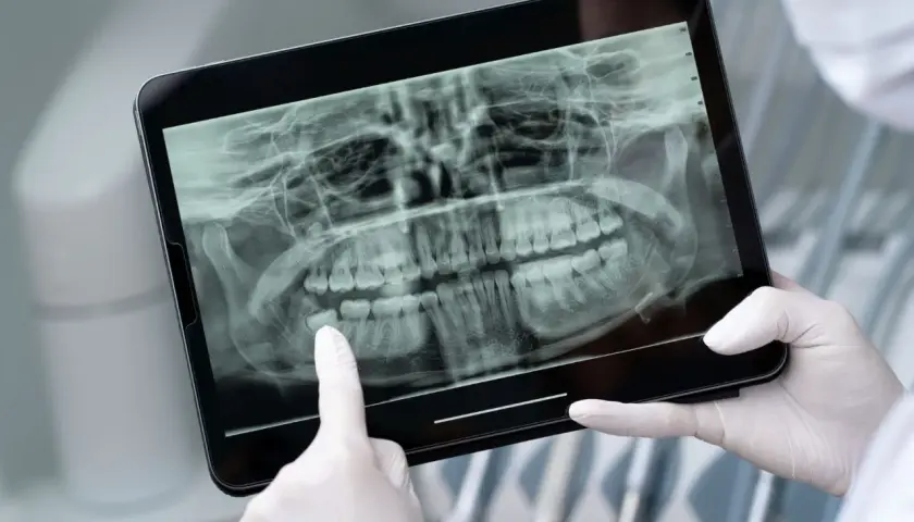 Dentysta analizuje RTG szczęki na tablecie, wskazując na ósemki. Decyzja, w jakim odstępie można wyrywać ósemki, zależy od ich położenia.