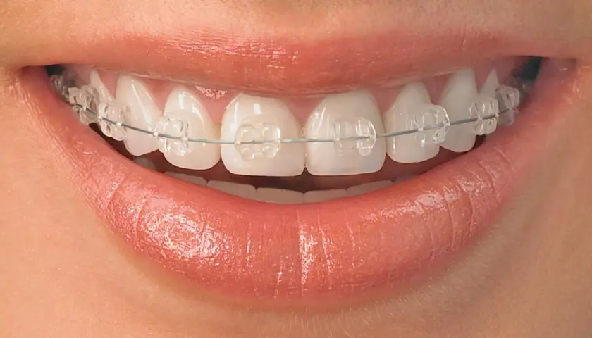 Sonrisa con brackets transparentes, mostrando dientes que necesitan brackets para alinearse y lucir perfectos.