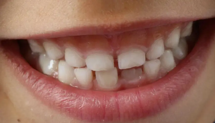 Sorriso di bambino con denti bianchi e sani, ma con segni di ipomineralizzazione denti bambini.