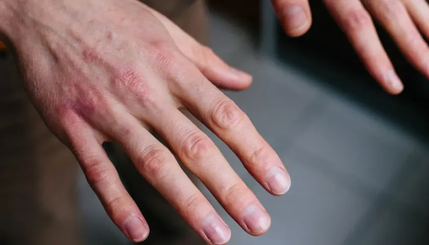 Manos con sabañones, piel enrojecida y seca en los nudillos, indicando posible irritación o frío.